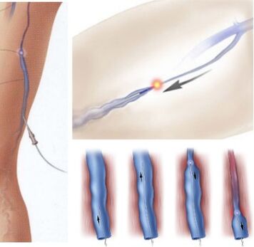 varikozu vēnu ārstēšanas metode - endovenoza lāzera koagulācija